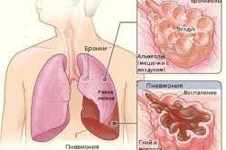 Схема болезни пневмонии