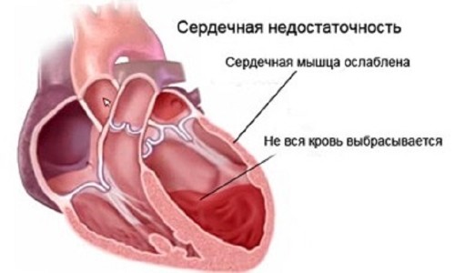 Схема левожелудочковой сердечной недостаточности