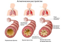 Бронхи при астме