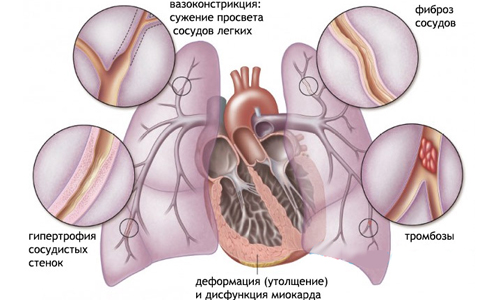 Схема легочного сердца