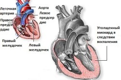 Сердце при миокардите