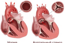 Схема аортального стеноза