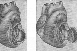 Степени развития аневризмы сердца