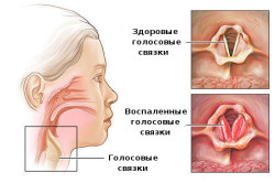 Воспаление голосовых связок при ларингите