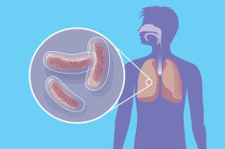 Туберкулез - причина сухого кашля