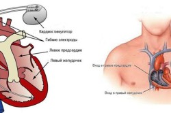 Вживление кардиостимулятора