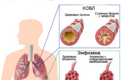 Схема хронической обструктивной болезни легких