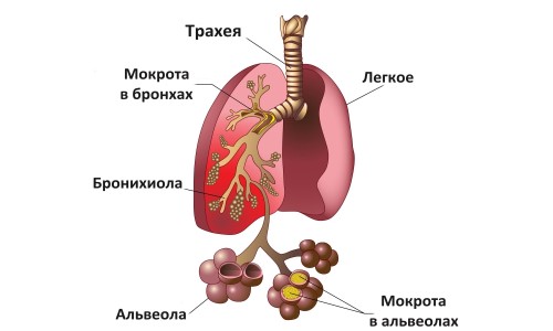 Схема пневмонии легких