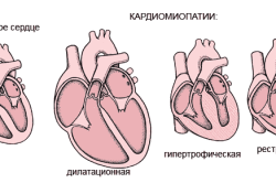 Сердце с кардиомипатией