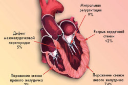 Основные причины миокардита сердца
