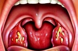Гнойные язвы в горле при ангине