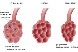 Воспалительные явления в легких