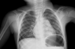 Рентгенограмма органов грудной клетки больного пневмонией