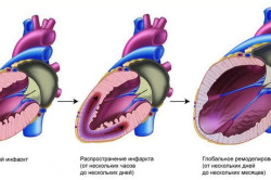 Развитие инфаркта при гипертонии