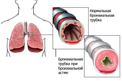 Бронхиальные трубки при астме