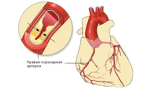 Закупорка артерий при ишемической болезни сердца