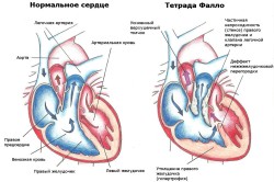 Схематическое изображение нормального сердца и с патологией