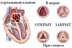 Аортальный клапан в норме и при стенозе