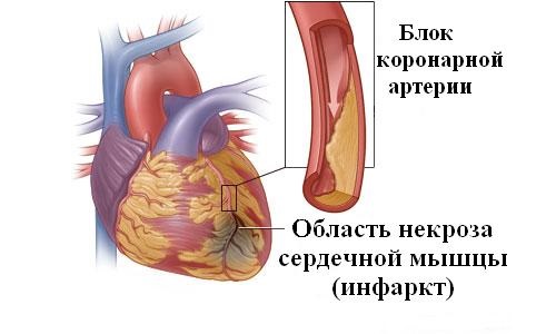Развитие инфаркта миокарда