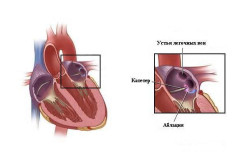 Схема абляции сердца
