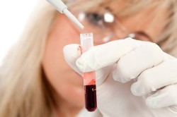 Исследование анализа крови при пневмонии