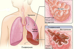Схема развития пневмонии