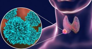 Ранні симптоми раку щитовидної залози